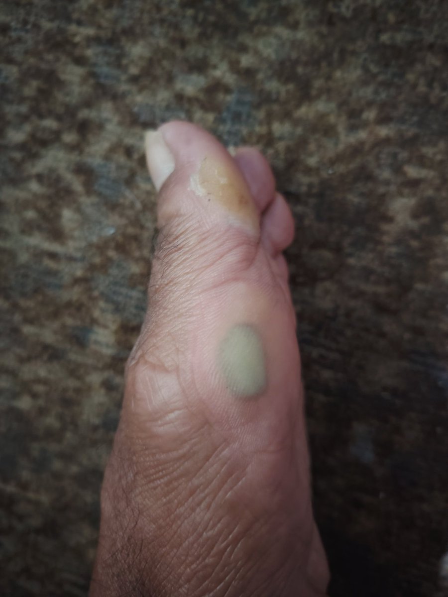 Blisters on my feet and aching legs are not going to stop me from getting the gains that God has in store for me.

Trust God always ✝️🙏🏾