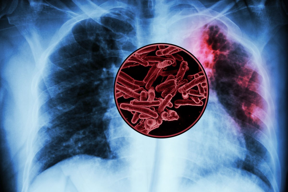 Ronald_vanLoon's tweet image. MIT study finds targets for a new tuberculosis vaccine
by Anne Trafton @MIT

Learn more: bit.ly/4oX2BJU

#MedTech #HealthTech #Tech #Healthcare #TechForGood
