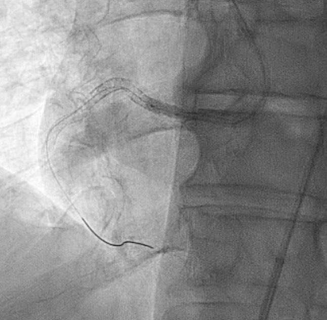 Ostial RCAs are challenging, including “nailing” the ostium. Previously missed ostial RCA case now with ISR of the stent and severe actual ostial stenosis. A few tips: 
1. Extreme LAO (&gt;50)
2. Note CA on sinus
3. Double wiring as a marker
4.  Mark with IVUS. 
5. Flare at the end