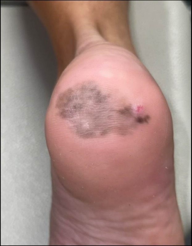 schowardjd's tweet image. A woman in her 50s presents with a 3.5 × 2.3 cm gray-brown macule w/ irregular borders on the plantar heel. It began 10 years ago and has recently enlarged &amp;amp; darkened. 

What’s the diagnosis❔