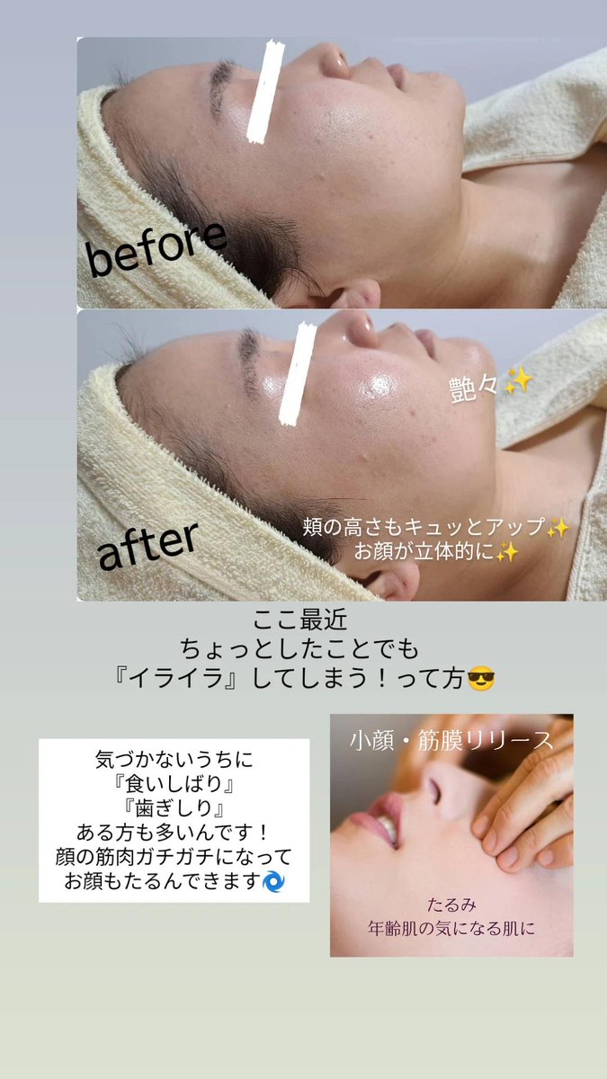 eminal_nico's tweet photo. たるみの原因！
『食いしばり』『歯ぎしり』も
顔の筋肉ガチガチさんも
たるみの原因になります🌀
【HotPepper予約👇️】
https://t.co/XTusDt41Zu https://t.co/mWzMO9hqn1