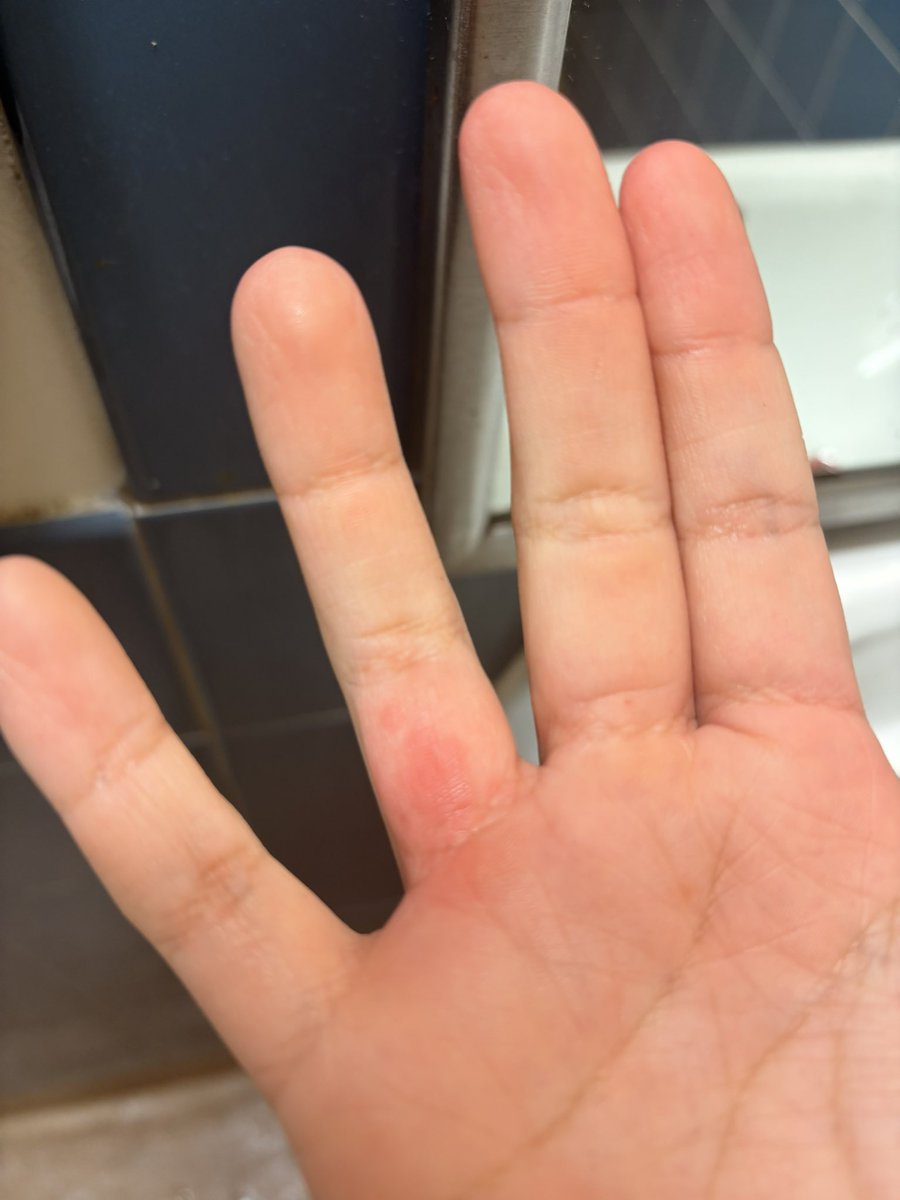 bulishrimp's tweet image. Has anyone ever experienced a skin reaction after purging? Im starting to get this red like mark after every purge🥲