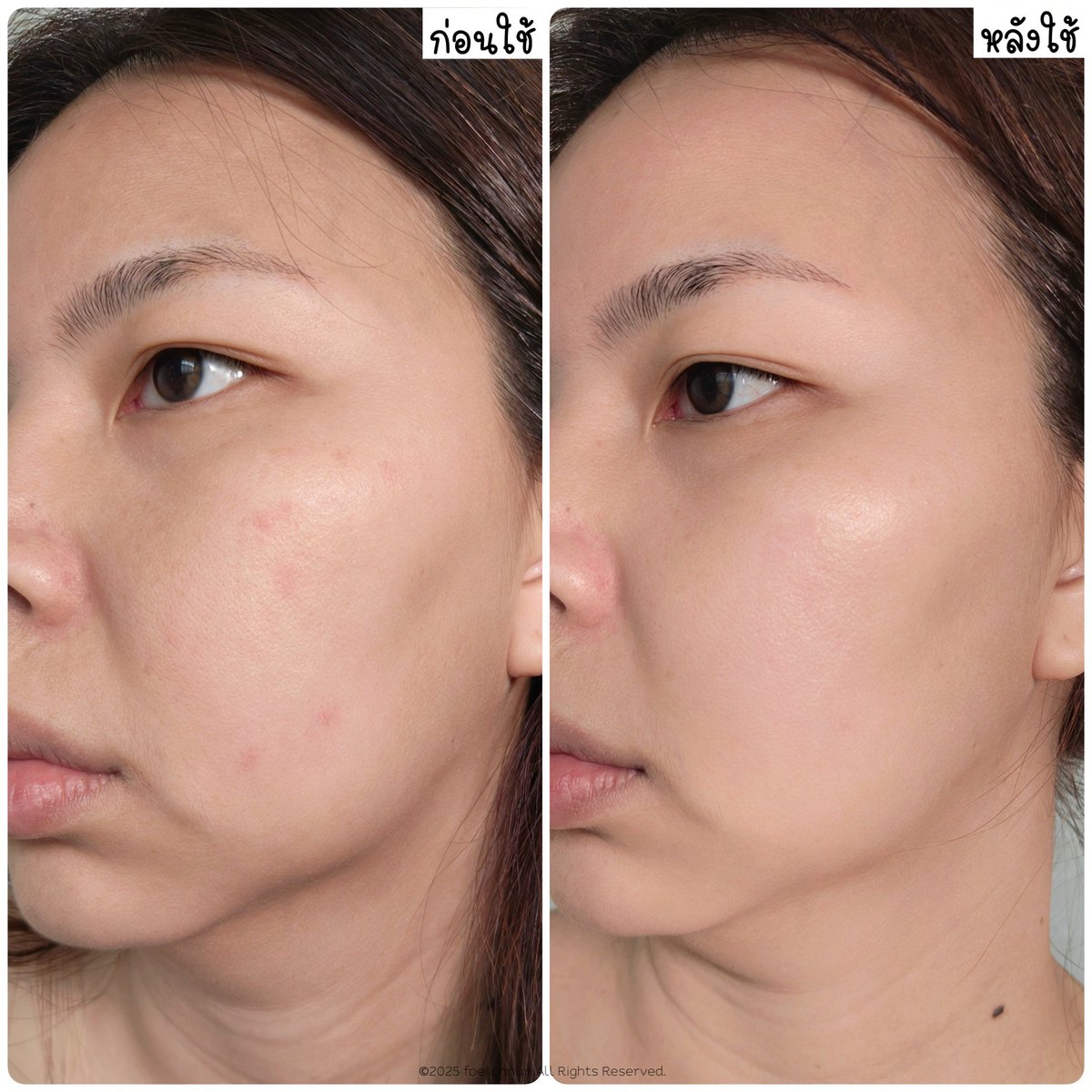 ใช้เซรั่มตัวนึงแล้วสิวขึ้นฉ่ำมาก โชคดีที่ได้ Cerave SA Cleanser ช่วยไว้ ฉันใช้มาตลอดไม่เคยห่างบ้าน! จัดการปัญหาสิว ผิวหยาบกร้าน ผิวอุดตัน ไม่เรียบเนียนได้ดีขึ้น ใครที่แต่งหน้าบ่อย เจอมลภาวะ ก็ใช้ตัวนี้เคลียร์ผิว ผลัดผิวเบาๆ ลดการอุดตันได้เลย ล้างออกง่าย ผิวสะอาด