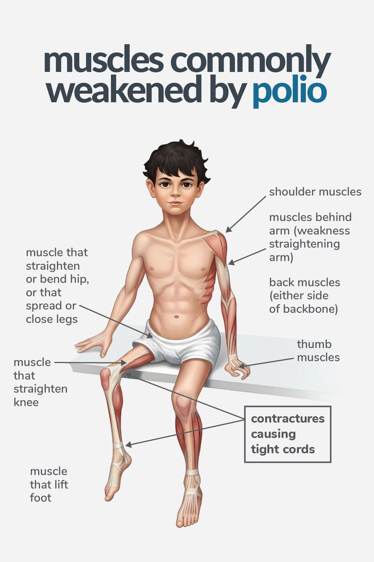 andrewjohnpub1's tweet image. Polio primarily affects the skeletal muscles, leading to muscle weakness and atrophy. It commonly impacts muscles in the legs, arms, and respiratory system.💪🦵💪🦾💔 #Polio #MuscleWeakness #MuscleAtrophy #PhysicalTherapy