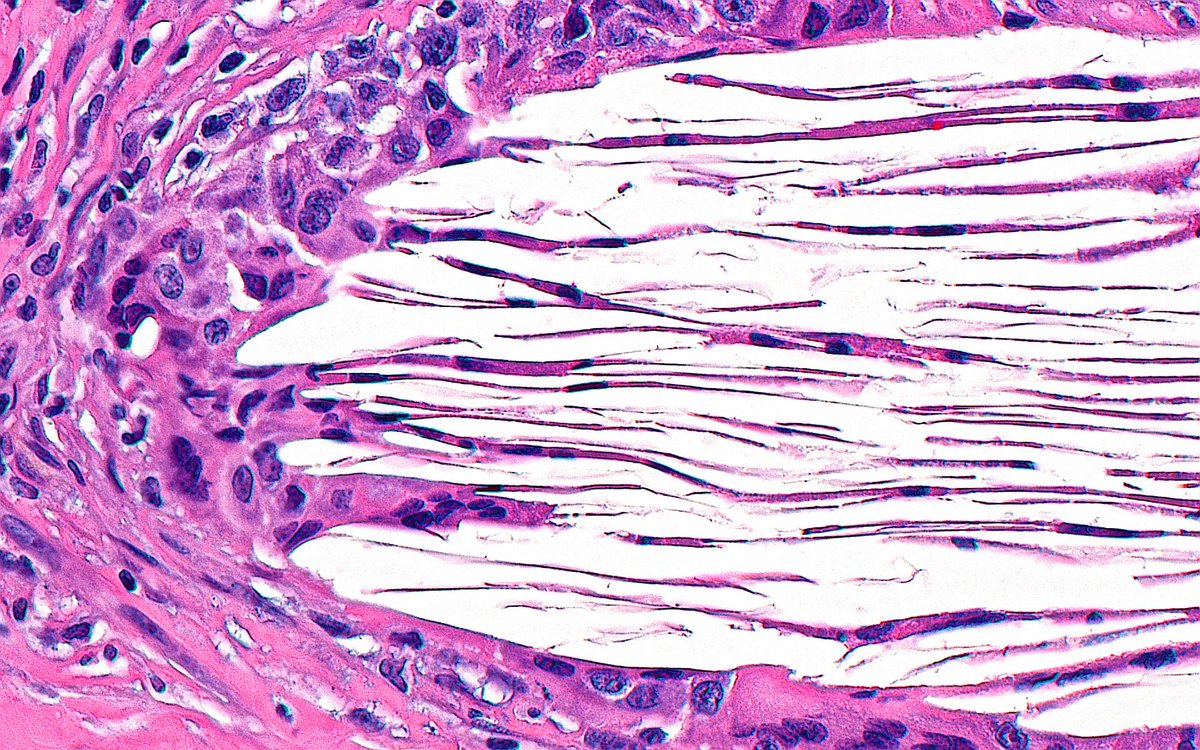 ziad_zaatari's tweet image. 🔬📷 Cholesterol Clefts ~ #Pathology #Histology #PathArt 🎨