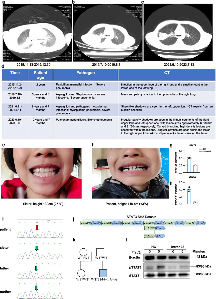 Mol_Biomed's tweet image. #Research 
STAT3 regulates NK and NKT cell differentiation through C-X3-C motif chemokine receptor 1  (CX3CR1) in hyper-IgE syndrome doi.org/10.1186/s43556…

#STAT3 #mutation #Hyper_IgE #syndrome #NKcell #CX3CR1