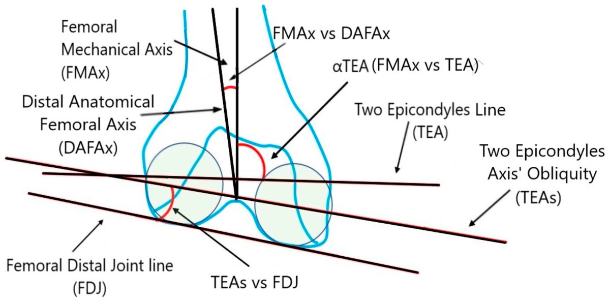 JPM_MDPI's tweet image. 🧠 Did you know...? “Only 26% of Native #Knees Show an Identical #Coronal Functional Knee #Phenotype in the #Contralateral Knee”

🧑‍⚕️by Manuel-Paul Sava et al. (Kantonsspital Baselland)
📊 2,938 Views | 📈 7 Citations
🔗 Dive into the study: mdpi.com/2075-4426/14/2…

#mdpijpm