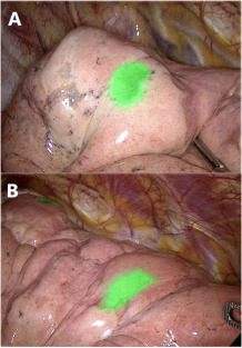Laparoscopic, Endoscopic and Robotic Surgery tweet media