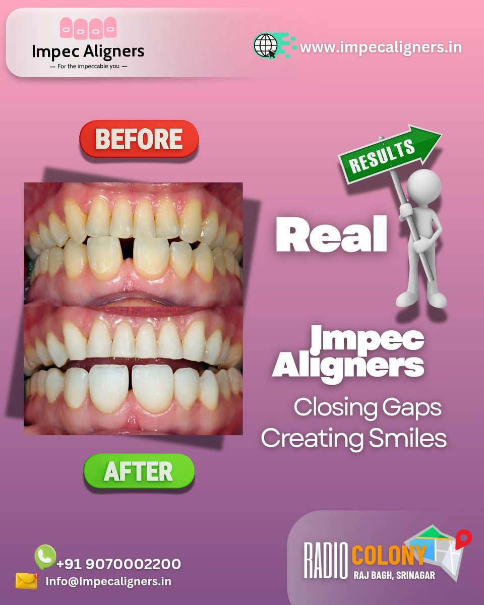 impecaligners's tweet image. Bridging the gaps, one confident smile at a time with Impec Aligners. 

Call or visit us today to start your smile journey!  

#ImpecAligners #SmileTransformation #GapToGlam #AlignWithImpec