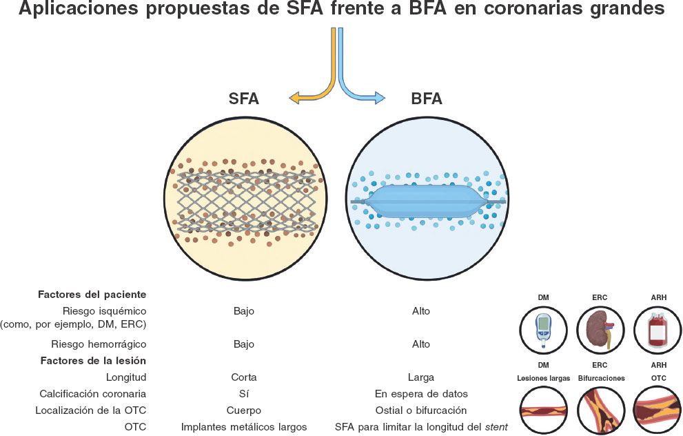 RevEspCardiol's tweet image. Balones farmacoactivos: a la conquista de la enfermedad coronaria de vaso grande #Aheadofprint @Antocol17 @leoneppmd recintervcardiol.org/es/editorial/b…