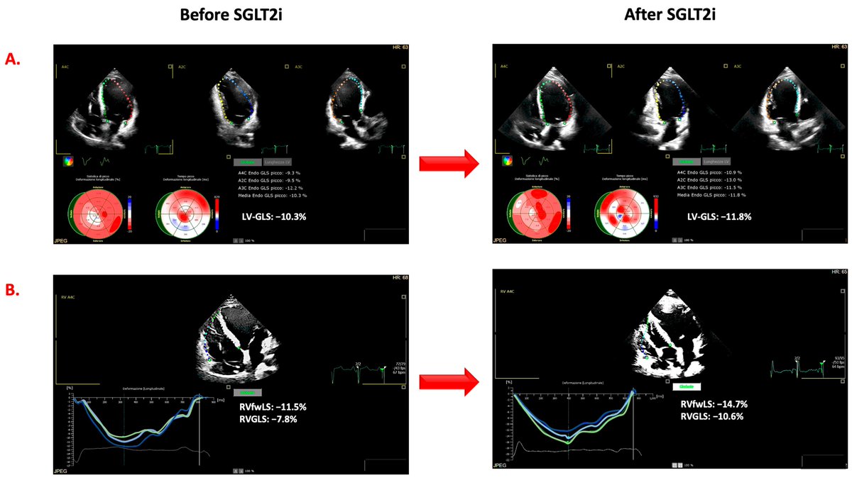 🚨 Interesting Article 🚨 
"Improvement in Left and Right Ventricular Function after Introduction of SGLT2 Inhibitors in Heart Failure Outpatients with Reduced Ejection Fraction" 
📚 By Gianmarco Alcidi et al.
🔗 brnw.ch/21wXuqI 
#HeartFailure #EjectionFraction