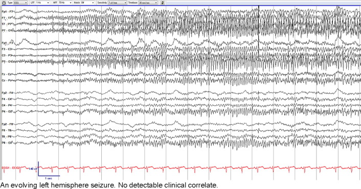 IFCN and its Clinical Neurophysiology journals tweet media