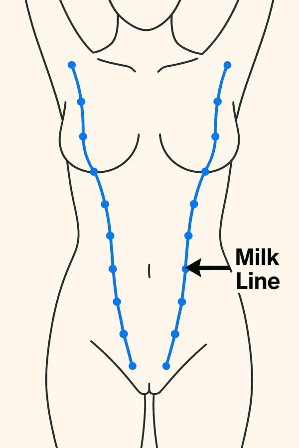 naruhach's tweet image. Aku pernah baca dr akun dokter
Jd jangan heran kalo asi bisa keluar dr mana aja
Trs ada bapak2 dg nipple lebih dr 2 atau bahkan nipple my bukan dtempat yg semestinya