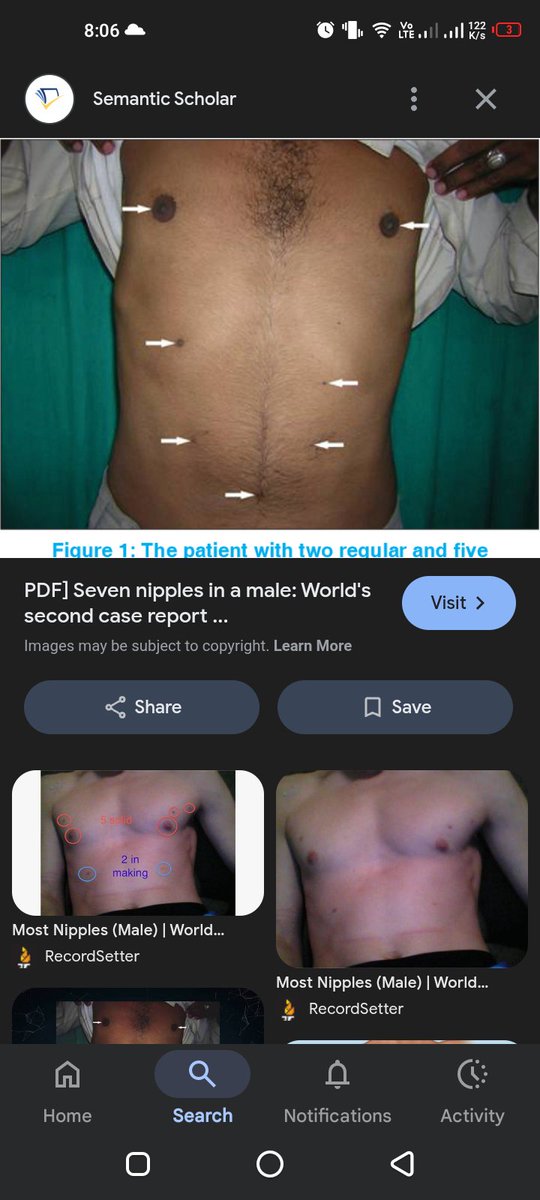 naruhach's tweet image. Aku pernah baca dr akun dokter
Jd jangan heran kalo asi bisa keluar dr mana aja
Trs ada bapak2 dg nipple lebih dr 2 atau bahkan nipple my bukan dtempat yg semestinya