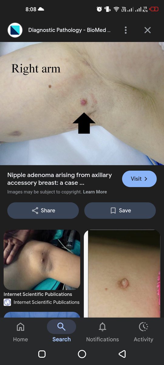 naruhach's tweet image. Aku pernah baca dr akun dokter
Jd jangan heran kalo asi bisa keluar dr mana aja
Trs ada bapak2 dg nipple lebih dr 2 atau bahkan nipple my bukan dtempat yg semestinya