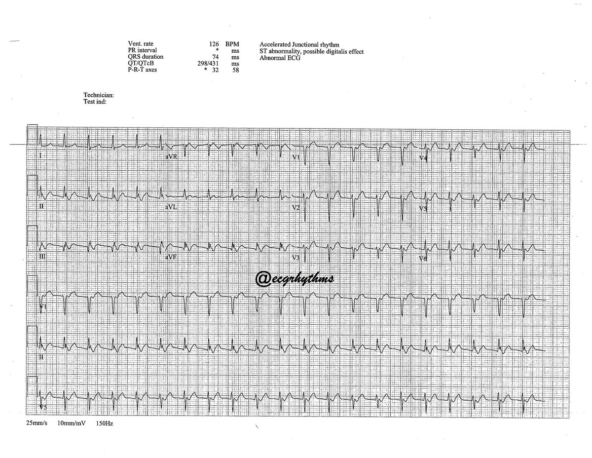 1/

111425

A 60M patient with palpitations.
2 leads &gt; 12L

What is the probable ECG interpretation?
Poll next