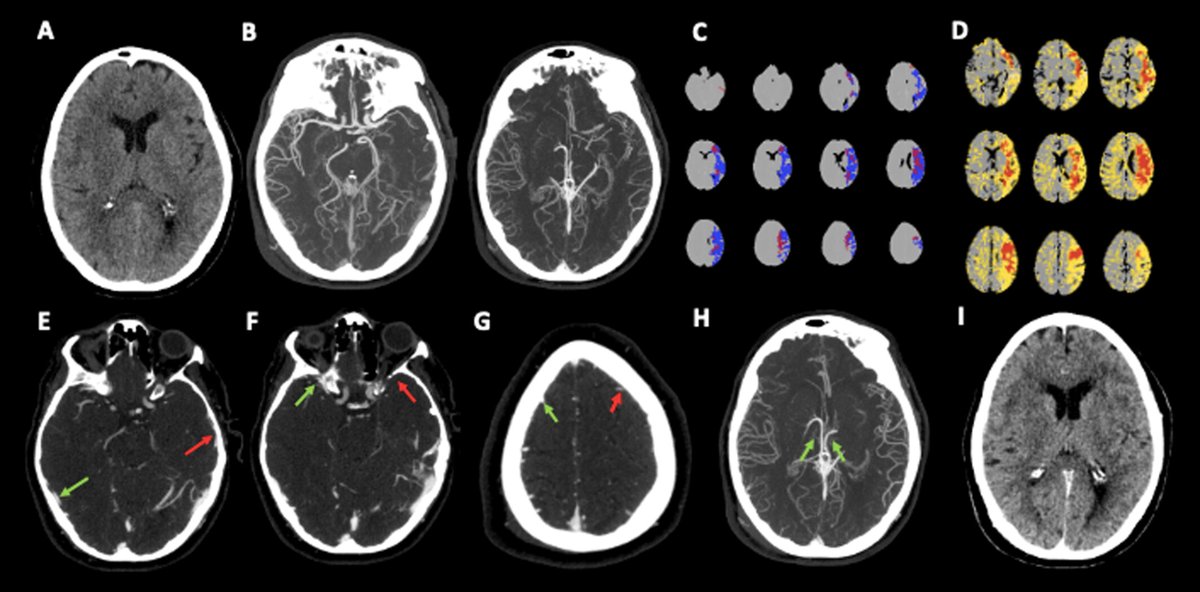 🧠Do not miss this...ORIGINAL ARTICLE at 
Wiley Online Library!
Comprehensive venous outflow is the optimal venous score in predicting functional outcome in acute ischemic stroke patients
Click on this🔗 doi.org/10.1111/eci.70…

✍️🏽GiorgioBusto  AndreaMorotti  IlariaCasetta