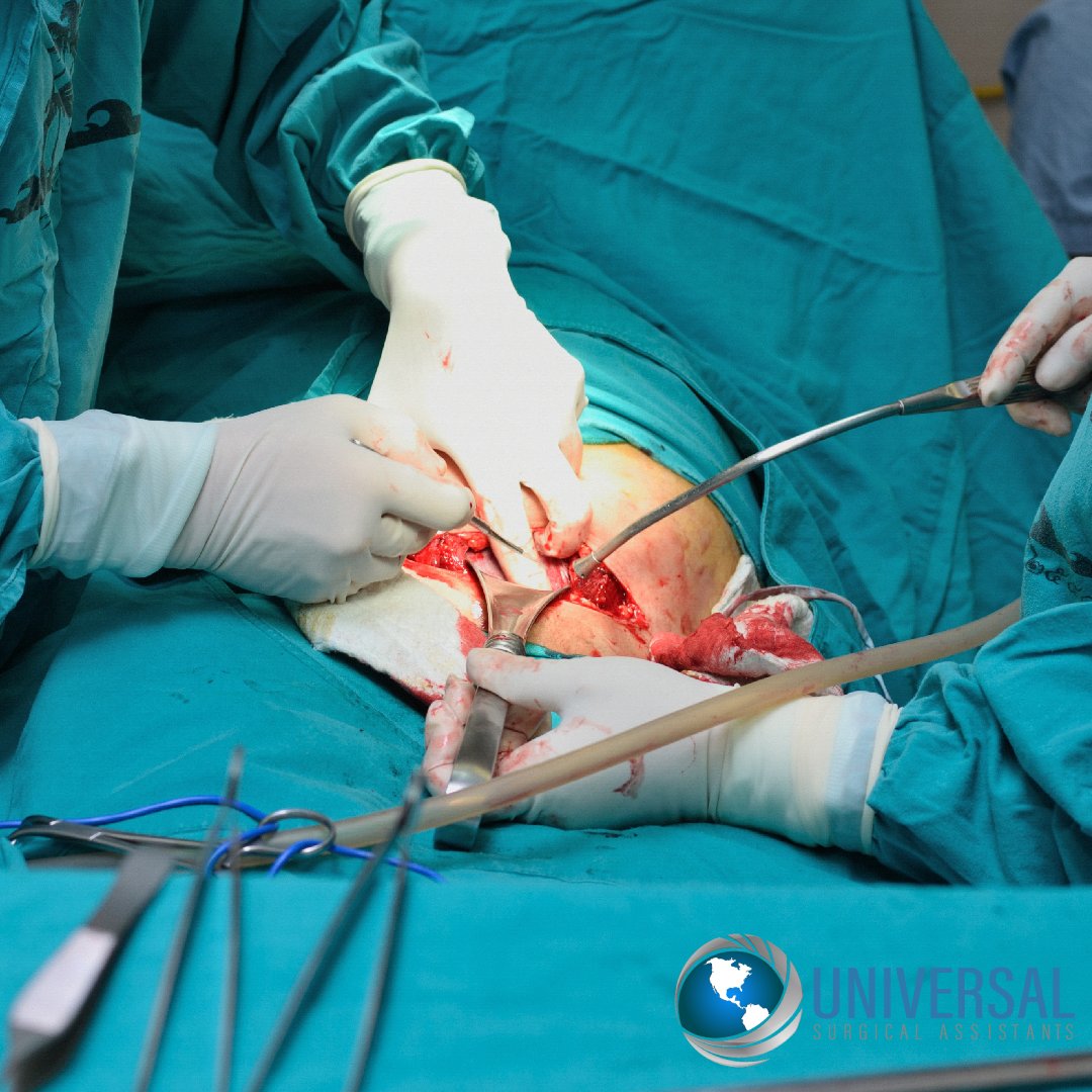 uspartnersinc's tweet photo. Major #surgery usually involves doctors cutting into your belly area, chest, or head in a hospital #operatingroom while patients are under anesthesia.
Our team of #Surgeon, #PhysicianAssociates, &amp; #SurgicalAssistant performs with the utmost care for a speedy patient recovery. https://t.co/KRWfFznTH9