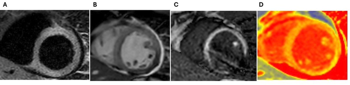 Heart_BMJ's tweet image. Cardiac imaging in oncology: the detection of cardiotoxicity heart.bmj.com/content/early/…
