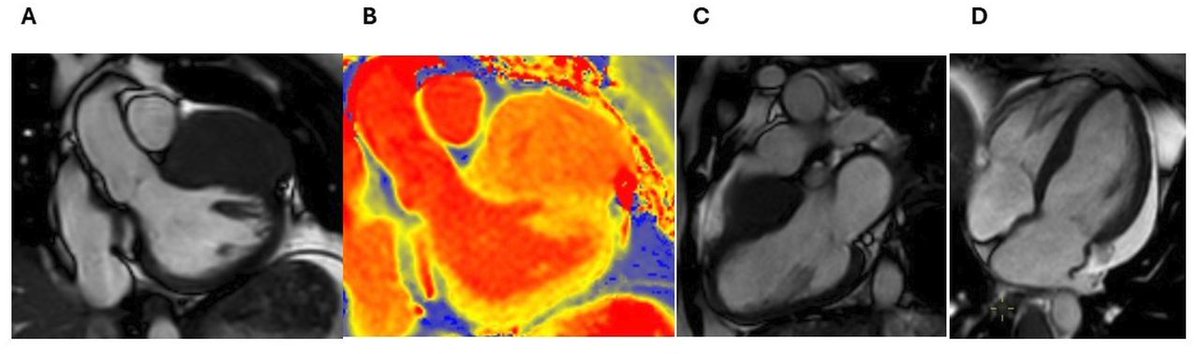 Heart_BMJ's tweet image. Cardiac imaging in oncology: the detection of cardiotoxicity heart.bmj.com/content/early/…