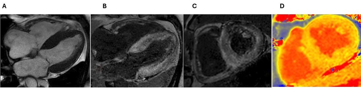 Heart_BMJ's tweet image. Cardiac imaging in oncology: the detection of cardiotoxicity heart.bmj.com/content/early/…