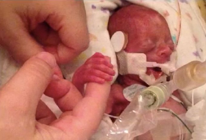 This is a premature baby born at 22 weeks.

Not a blob of tissue.

Not a clump of cells.

A human being.