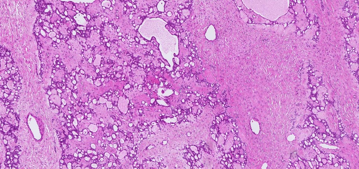 RunjanChetty's tweet photo. Ovarian tumour. https://t.co/FgDVRHsTMy