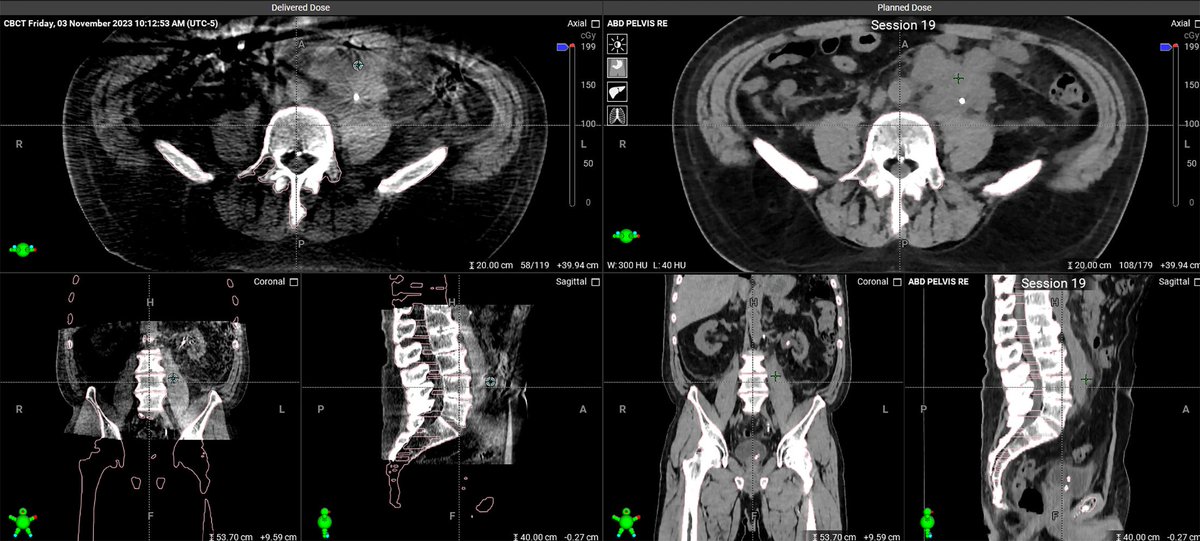 Applied_RadOnc's tweet image. The Use of Adaptive Radiation in a Retroperitoneal Seminoma Patient with Poor Candidacy for Chemotherapy: A Teaching Case
 
🔗 zurl.co/O5wa9 

#radonc #radonced #menshealth #movember