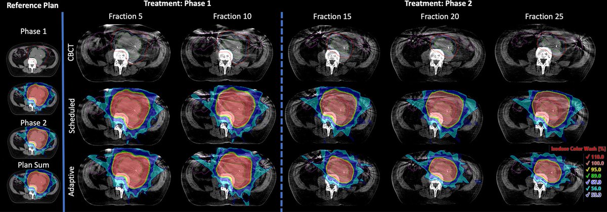 Applied_RadOnc's tweet image. The Use of Adaptive Radiation in a Retroperitoneal Seminoma Patient with Poor Candidacy for Chemotherapy: A Teaching Case
 
🔗 zurl.co/O5wa9 

#radonc #radonced #menshealth #movember