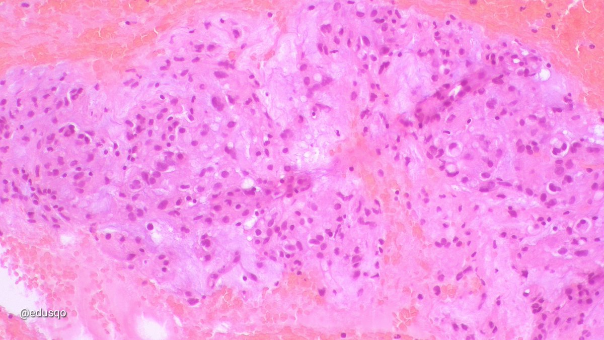 edusqo's tweet photo. Epithelioid gastrointestinal stromal tumor GIST with myxoid changes:
▫️Bland epithelioid round/oval cells.
▫️Metachromatic myxoid stroma
▫️Cytoplasmic perinuclear vacuoles
▫️Nuclear pseudoinclusions 👈🏾
▫️#CellBlock w #IHCPath for CD117/DOG1 +
#EUSFNA #CytoPath #FNAFriday #ROSE https://t.co/XOxQOI46nX