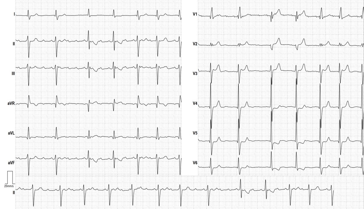 ECG without further details. Please name the abnormalities. <a href="/WaqarKh55444902/">Dr Waqar Khan</a> <a href="/jalosmar/">jalosmar</a> <a href="/HarshitMis56211/">Harshit Mishra</a> <a href="/healthefyheart/">Doctor Dilwala ❤️‍🩹</a> <a href="/moamen5298/">Momen Mohamed Ibrahim</a> <a href="/QRSfans/">ECGdude</a> <a href="/himonzy_papa/">himonzy_papa</a> <a href="/rosh_anak/">נפתול</a> <a href="/DrJNELLY95/">Dr J NELSON OKEMA, MD 🇬🇧</a> <a href="/nelsonpol/">Nelson Polo Taborda</a> <a href="/OungSavly/">Oung Savly MD FACC FASE FESC FAAP FAPSC 🇰🇭</a> <a href="/notkillingeve/">it’s in the cards 🫀</a> <a href="/TruthinMindBody/">John W Wang</a> <a href="/healthefyheart/">Doctor Dilwala ❤️‍🩹</a>
