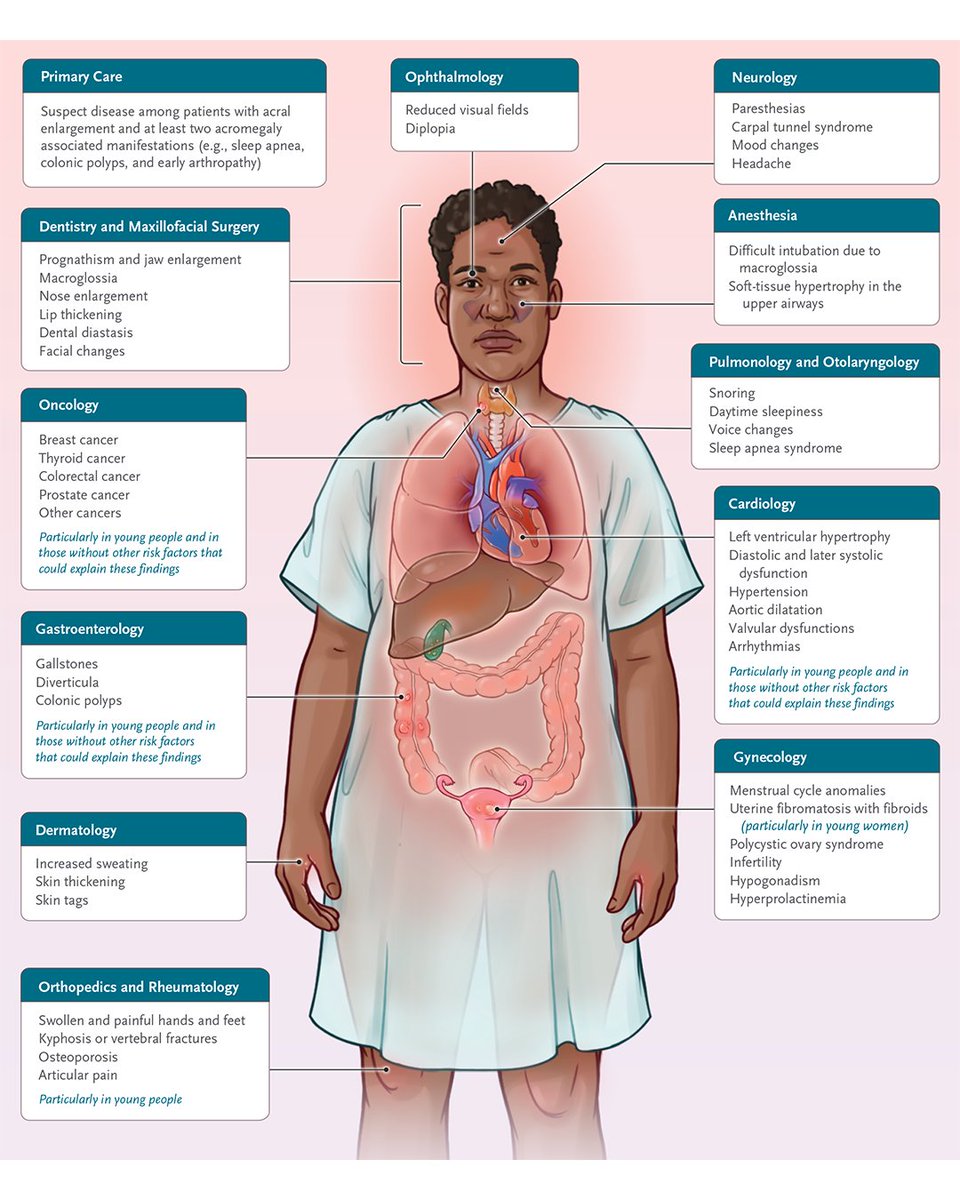 NEJM's tweet image. A new review by Andrea Giustina, MD, and Annamaria Colao, MD, PhD, updates the pathophysiology and disease course of acromegaly, focusing on the general clinician’s key role in early diagnosis and management. 

At diagnosis, approximately 70% of patients with acromegaly have…