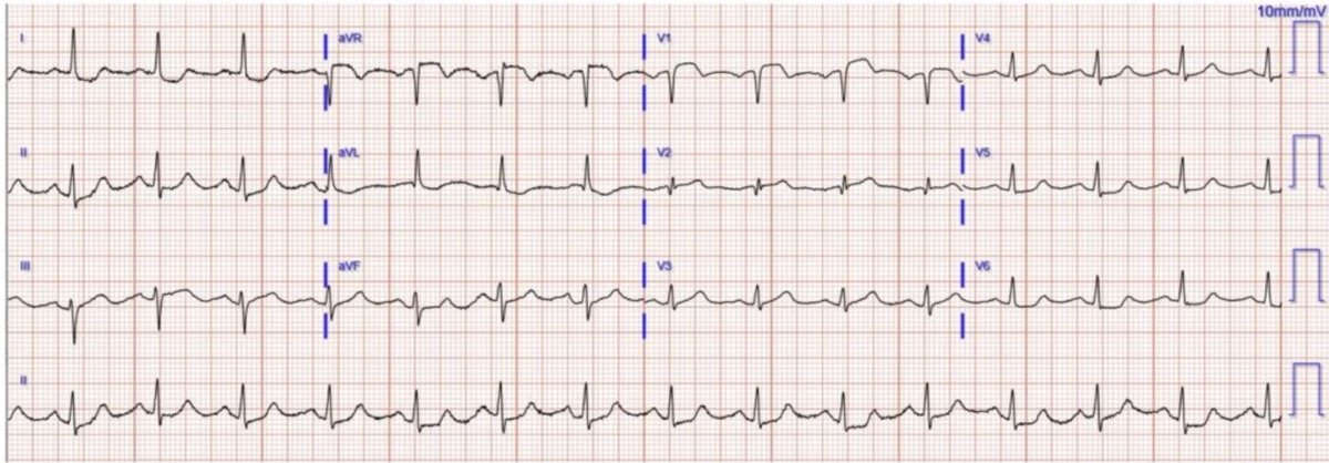 A woman in her 50s with chest pain. No diagnostic STE (that worthless diagnosis: “NSTEMI”). What is it and what happened?

drsmithsecgblog.com/a-woman-in-her…