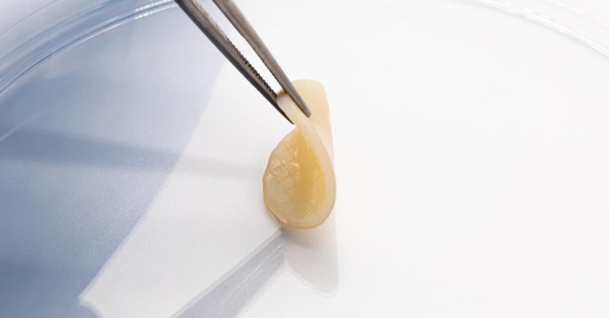 Revolutionize cartilage restoration with ProChondrix CR! 🌟 This cutting-edge solution, a laser-etched, cryopreserved osteochondral allograft, provides the essential components for restoring articular cartilage. Learn more:  brnw.ch/21wXuLg #carilage #kneesurgery