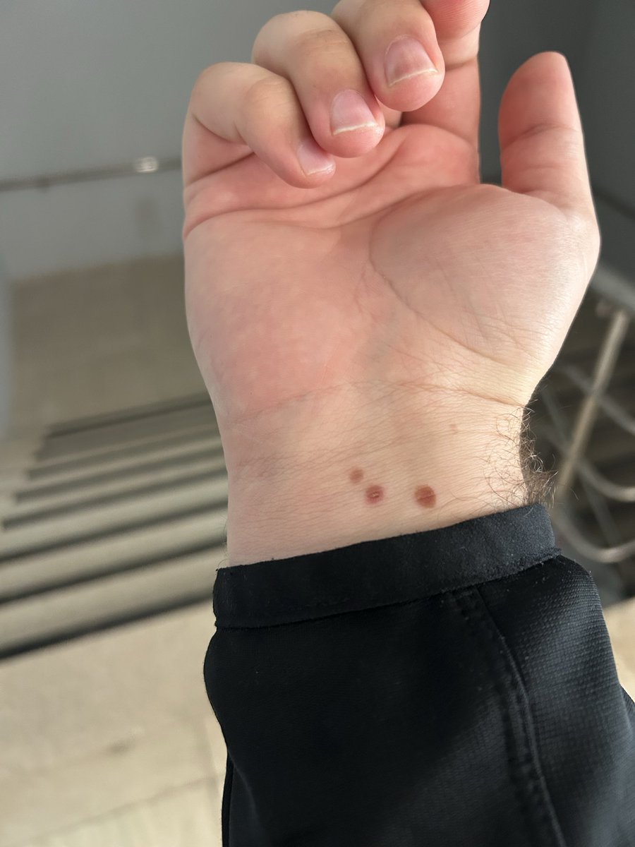 Bileğime yağ sıçradı ve böyle oldu. Çok hoşuma gitti, birazcık istemiyor gibiyim iyileşmesini 🥹