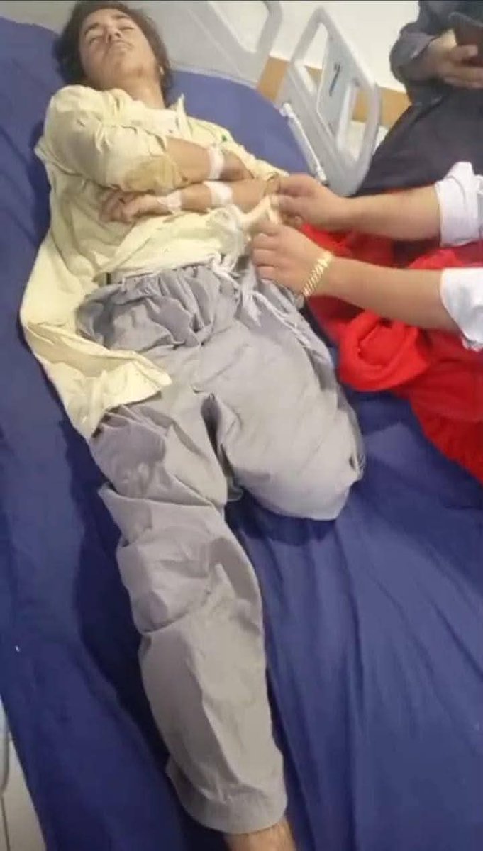 په تیراه دره کې د واده په مراسمو د ډرون برید  شوې؛ د ټپي شویو کسانو څخه یو، عثمان د خیال خان زوی، معزور شو؛ یوه پښه یې له لاسه ورکړه 
#StopStateTerrorism