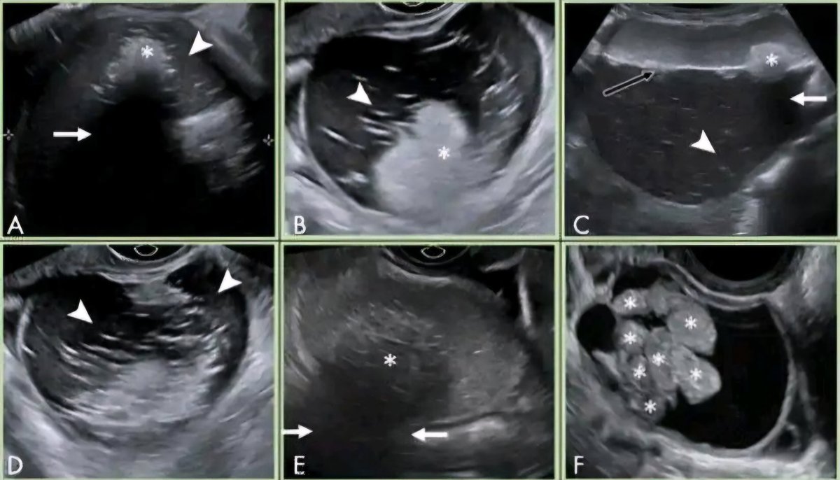 mznljrdy47597's tweet photo. Typical Dermoid Cysts
Dermoid cysts (mature cystic teratomas) often show a highly echogenic mural component shadowing from calcified or fatty elements, and a characteristic tip-of-the-iceberg” appearance due to sound attenuation.
#Ultrasound #sonologist #DermoidCyst #Teratoma https://t.co/1yX7q4KlUQ