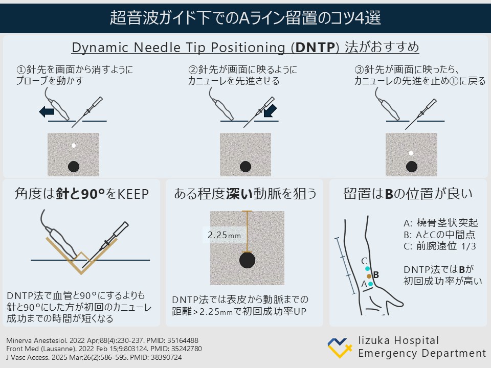 iiduka_kyukyu's tweet image. 【ちょっとふかぼり 救急診療トピックス】🚑
勤務終わりにサクッと“振り返り”を実施中！
研修医/専攻医のリアルな疑問&amp;amp; 指導医のTipsを共有し、学びを深掘りしています📚
そのエッセンスをSNSで発信中🛜
今回のテーマは【超音波ガイド下でのAライン留置】です！