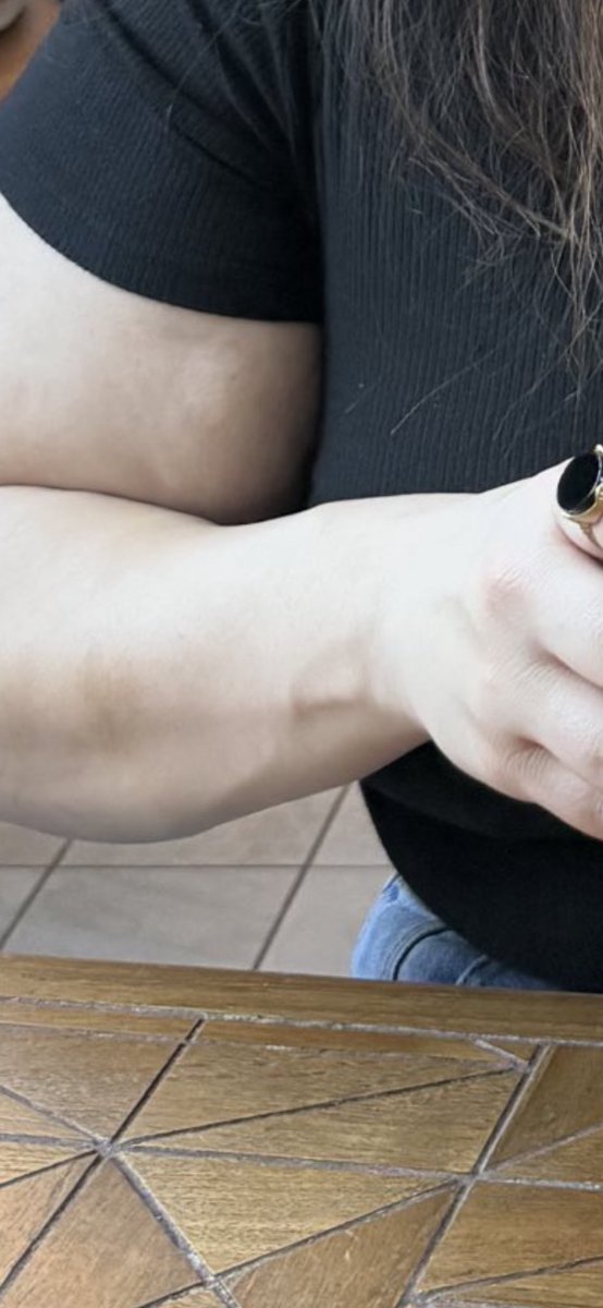 Yet vascular (1 Vein)?  Even still one vain is better than no brain. I mean no vein.😂😂😂😂