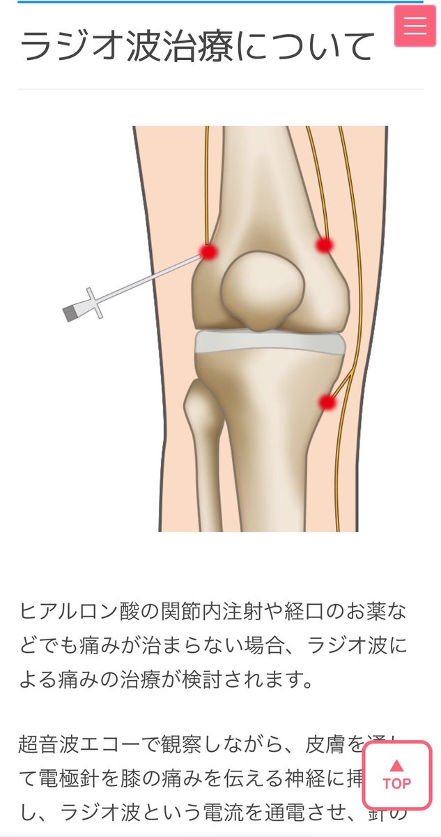 変形関節症の膝のクーリーフ手術を受けたよ
（末梢神経をバカにする手術）
めためたいたかった
1〜2年は痛みを感じにくくなるみたい