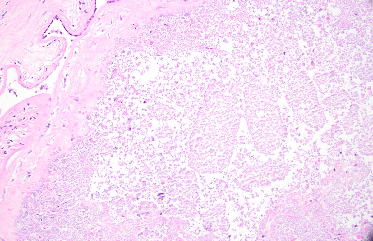 dgbrackett's tweet photo. @leon_metlay @leon_metlay Would you call this a yolk sac remnant? (POC specimen, missed abortion) #placentapath #obpath https://t.co/gbG5dkr0Fw