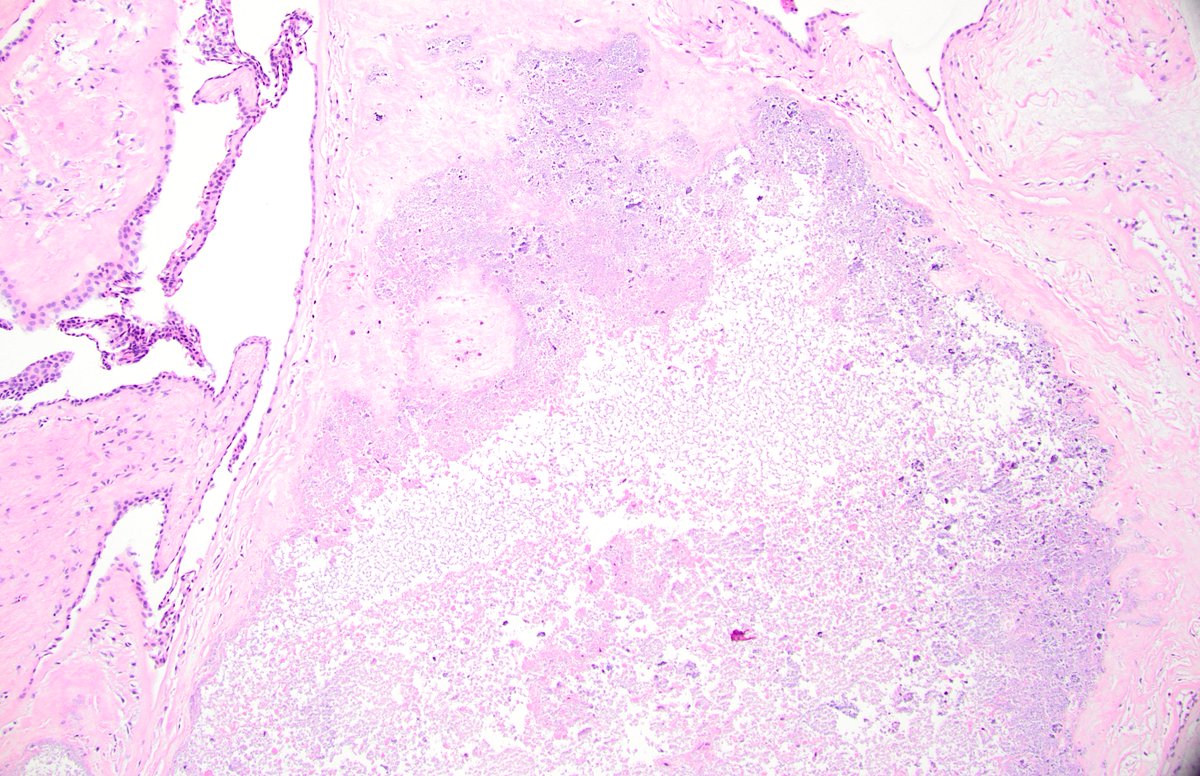 dgbrackett's tweet photo. @leon_metlay @leon_metlay Would you call this a yolk sac remnant? (POC specimen, missed abortion) #placentapath #obpath https://t.co/gbG5dkr0Fw