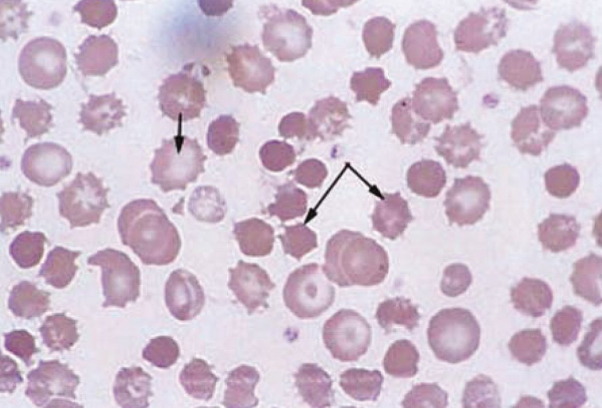 A 56 year old presents with hematemesis 😭

Pancytopenia on blood work.

Hgb 56 g/L
WBC 1.2 x 10^9/L
Plt 45 x 10^9/L

Smear 👇🏽

What do you see?
Ddx?
Management?