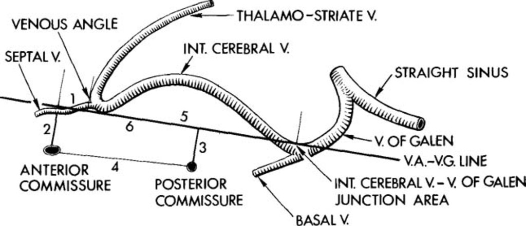 IvanGHMD's tweet photo. The junction of the septal vein and thalamostriate vein with the internal cerebral vein is called the venous angle angiographically. https://t.co/v4HVYMdS6r