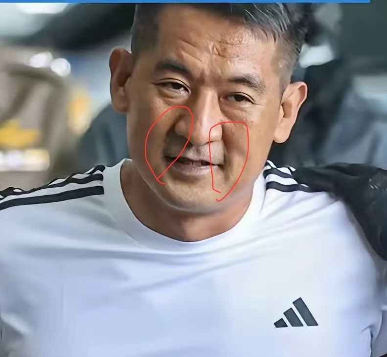 zhenshadawang's tweet photo. 余智江被引渡回国。典型的法令入口，富不久远，法令入口的人成绩越大灾难越大。汉朝时邓通铸造铜钱，富甲天下。女相师许负确断言其饿死街头也是因为法令入口。这就是“法令入口，邓通饿死野人家”。现代社会很难饿死，算是大灾难。 https://t.co/2p6loVYiJb