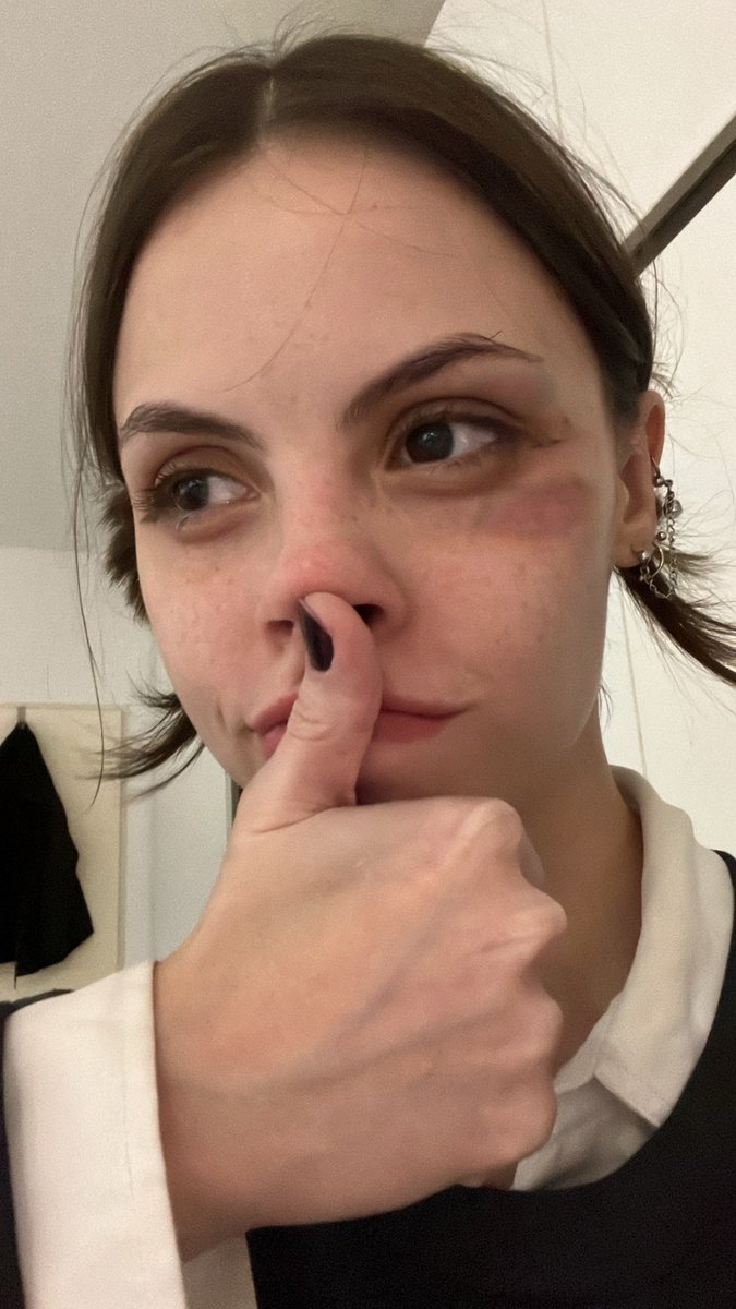 No sé preocupen a esta trolita le pegue con la pija en la cara por eso el moretón, pasa que le falta leche y calcio entonces la estoy culiando hasta que se le  vaya el hambre