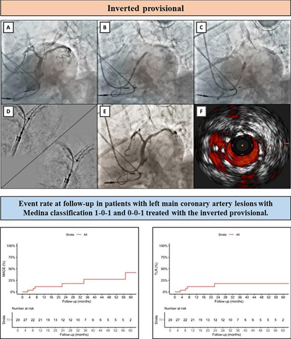 📌Inverted provisional technique for left main bifurcations (Medina 1,0,1 - 0,0,1)
💥 100% procedural success, low crossover to 2-stent strategy (3%).
🫀 At 3 years: low MACE (20.7%) and TLR (13.8%).
🔍Useful technique in left dominance and large LCx.

🔗sciencedirect.com/science/articl…