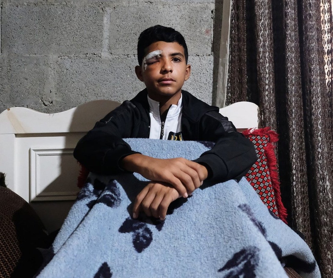 Nazih Masalma wartete auf den Schulbus, als ein israelischer Soldat aus seinem Militärjeep stieg und ihm aus 5 Metern Entfernung eine Tränengaskartusche ins Gesicht schoss. Danach stieg er wieder ein und fuhr weiter, als wäre nichts geschehen.
Nazihs Auge wurde so schwer