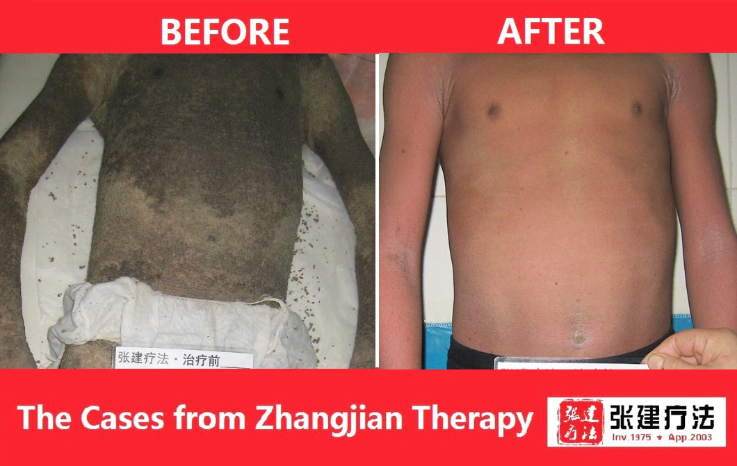 ZJTherapy's tweet image. 🤗Ichthyosis treatment 

Can you imagine this ichthyosis skin change?

🤝If you want to know more about your skin, see successful ichthyosis treatment cases and skin care tips, please contact us to send you ichthyosis book. 
☎️Contact us: wa.me/message/A6E3X3…
 #Ichthyosis