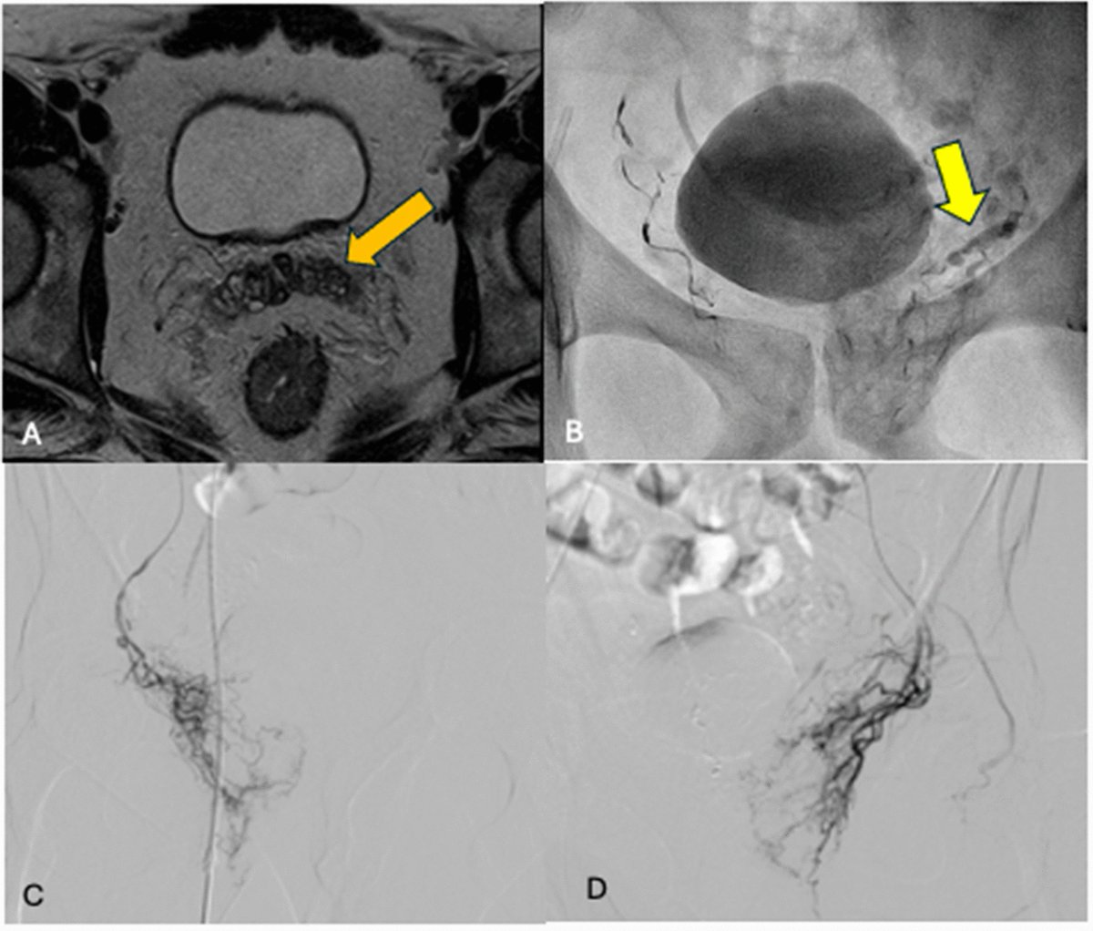CVIR_Journal's tweet image. #LettertoEditor 📬
Prostatic Artery Embolization for Refractory Hematospermia Without Hematuria
link.springer.com/article/10.100…